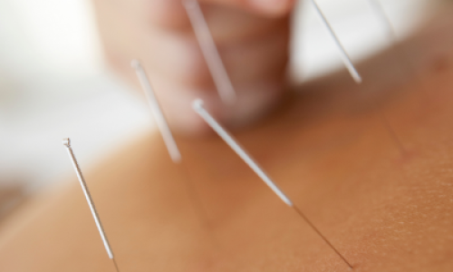 acupuntura_01